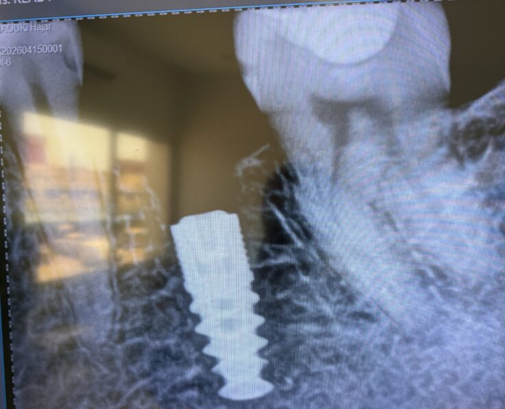 Implants dentaires à Bouznika