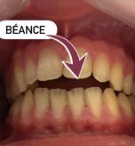 beance2