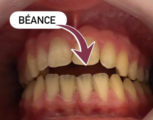beance2