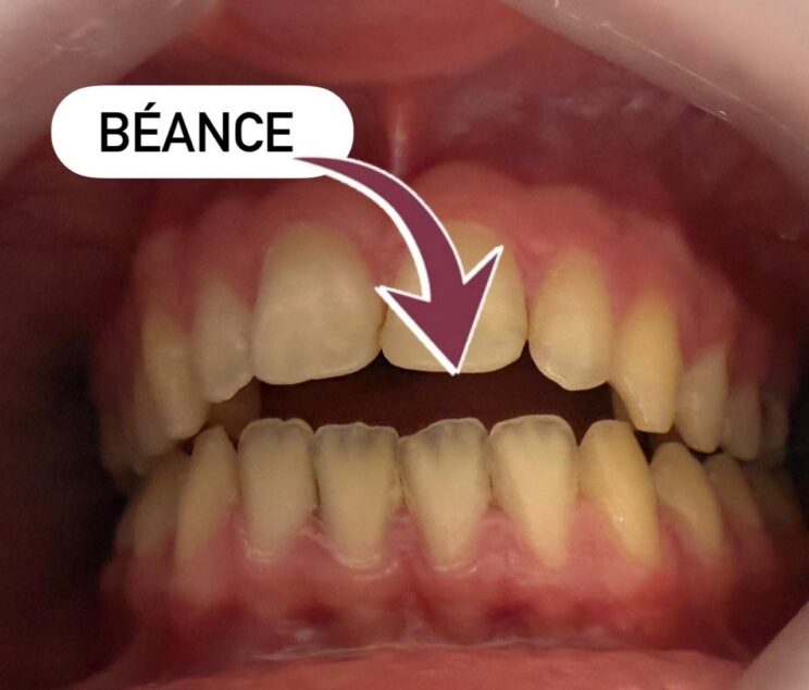 beance2